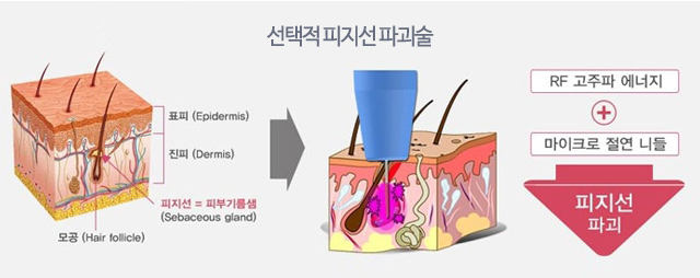 선택적 피지선 파괴술의 원리