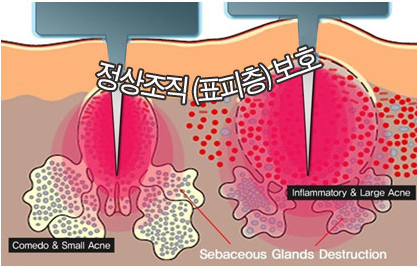 정상조직 보호