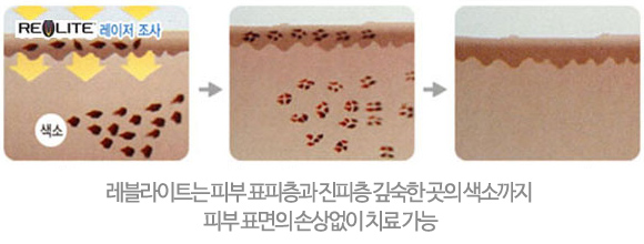 레블라이트 치료 과정